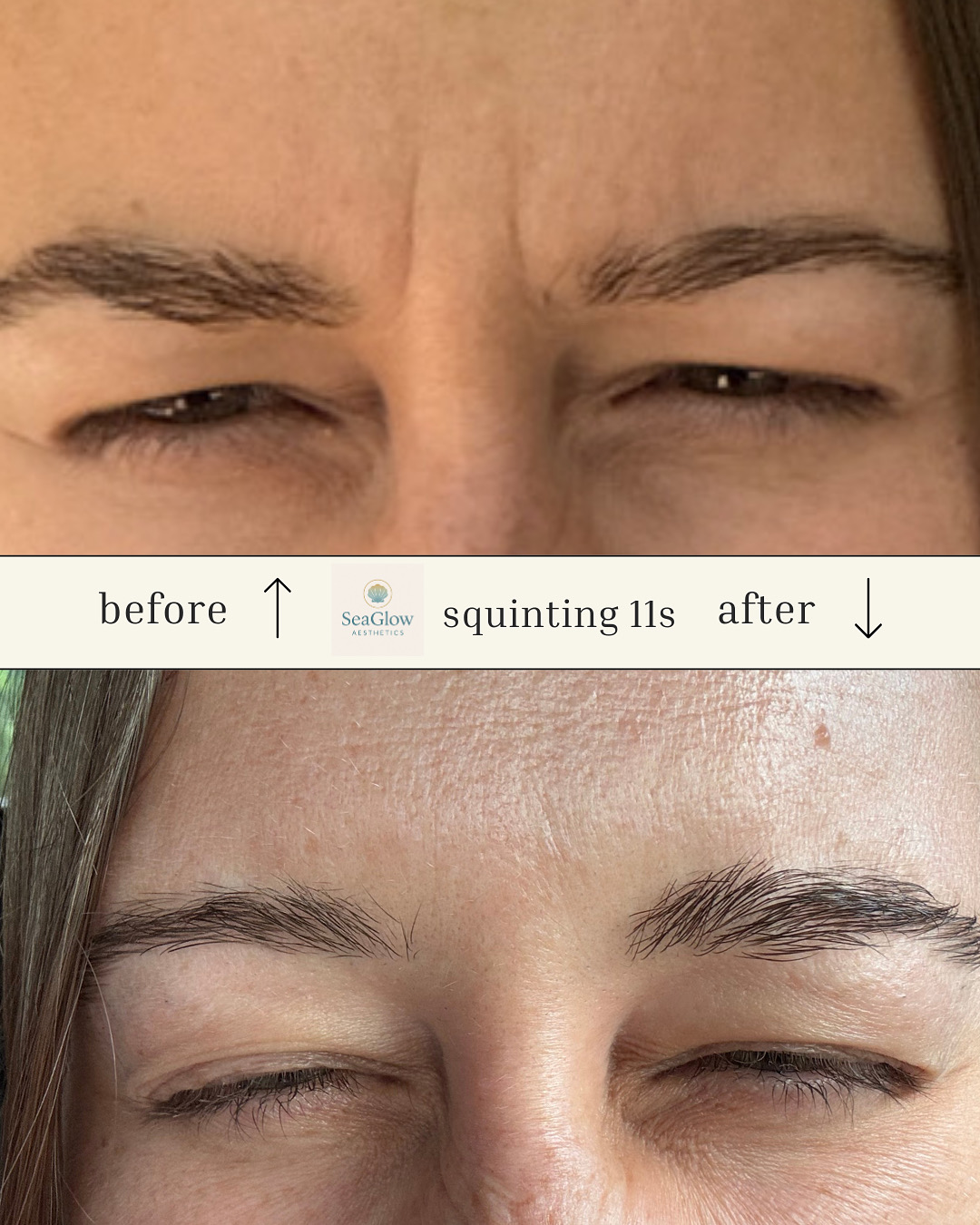 Before and after squinting 11s Botox treatment – SeaGlow Aesthetics