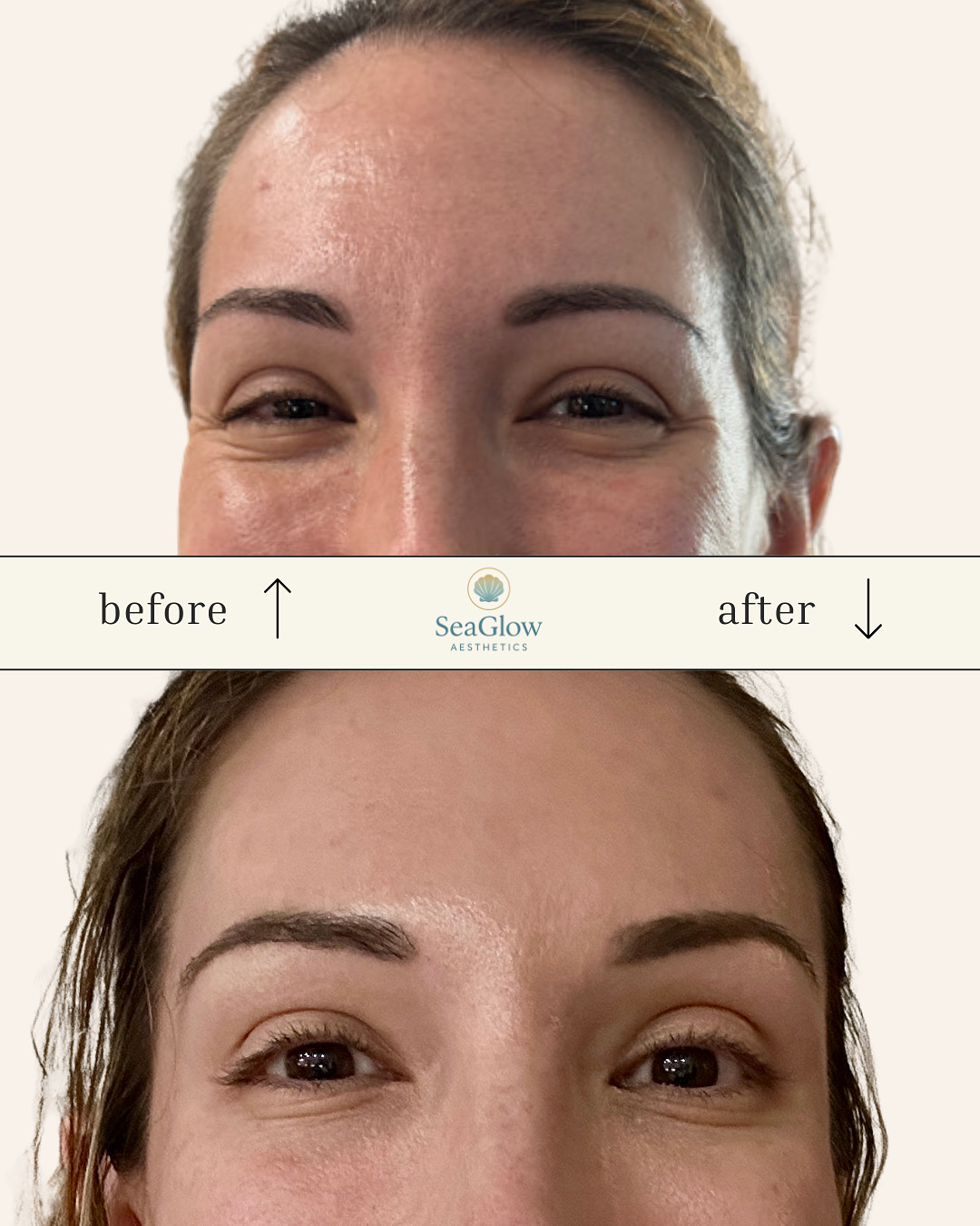 Before and after forehead and eye area Botox – SeaGlow Aesthetics