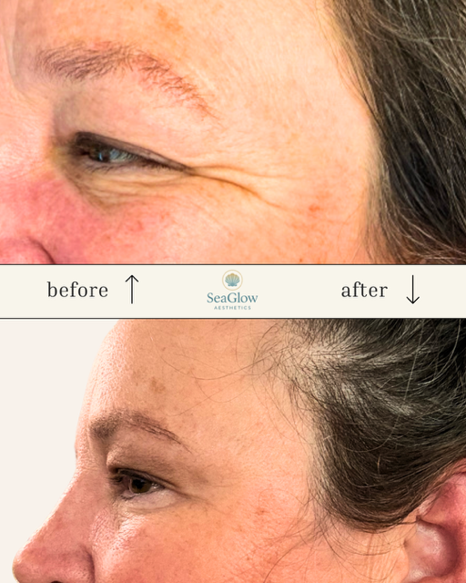 Before and after crow's feet Botox treatment – SeaGlow Aesthetics