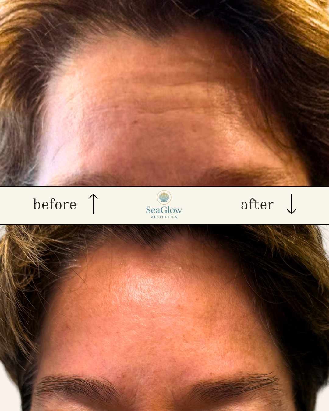 Before and after forehead lines Botox – SeaGlow Aesthetics