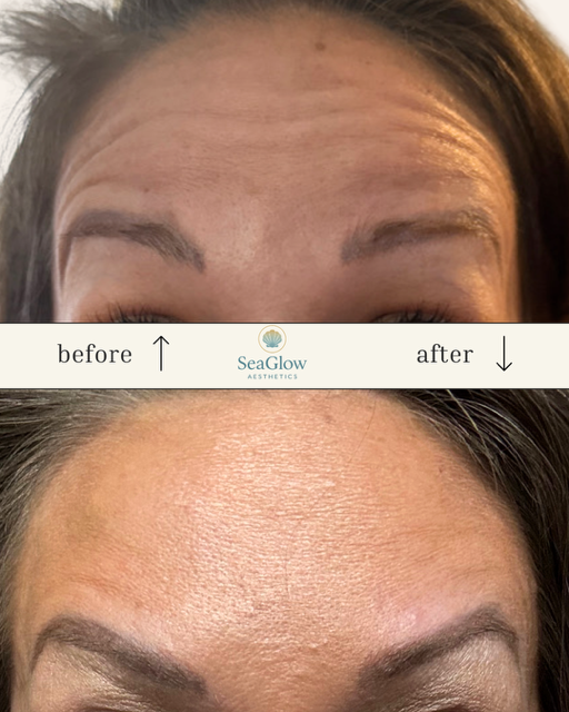 Before and after forehead wrinkles Botox treatment – SeaGlow Aesthetics