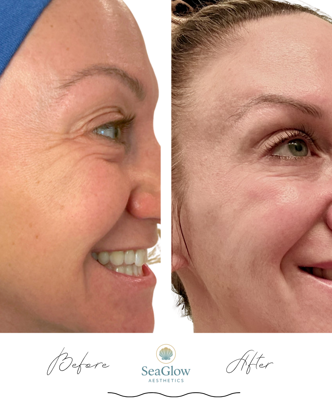 Before and after crow's feet Botox treatment – SeaGlow Aesthetics